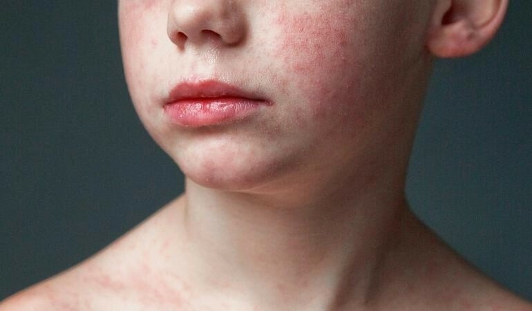 Vaccineren